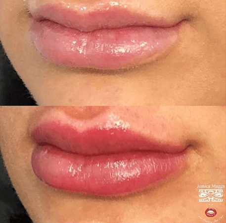 1ml of Lip filler @jessica_maggs for Amazing results